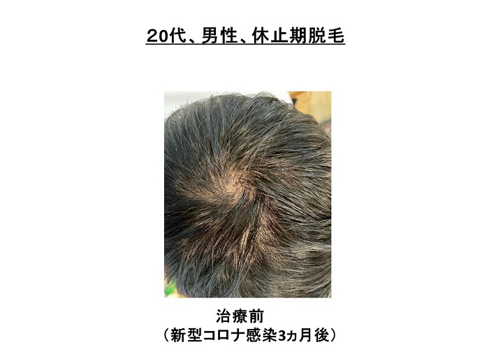 新型コロナ　脱毛　治療
